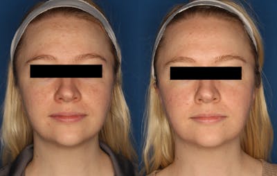 HALO® Laser by Sciton Before & After Gallery - Patient 148021521 - Image 1