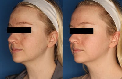 HALO® Laser by Sciton Gallery Before & After Gallery - Patient 148021521 - Image 2