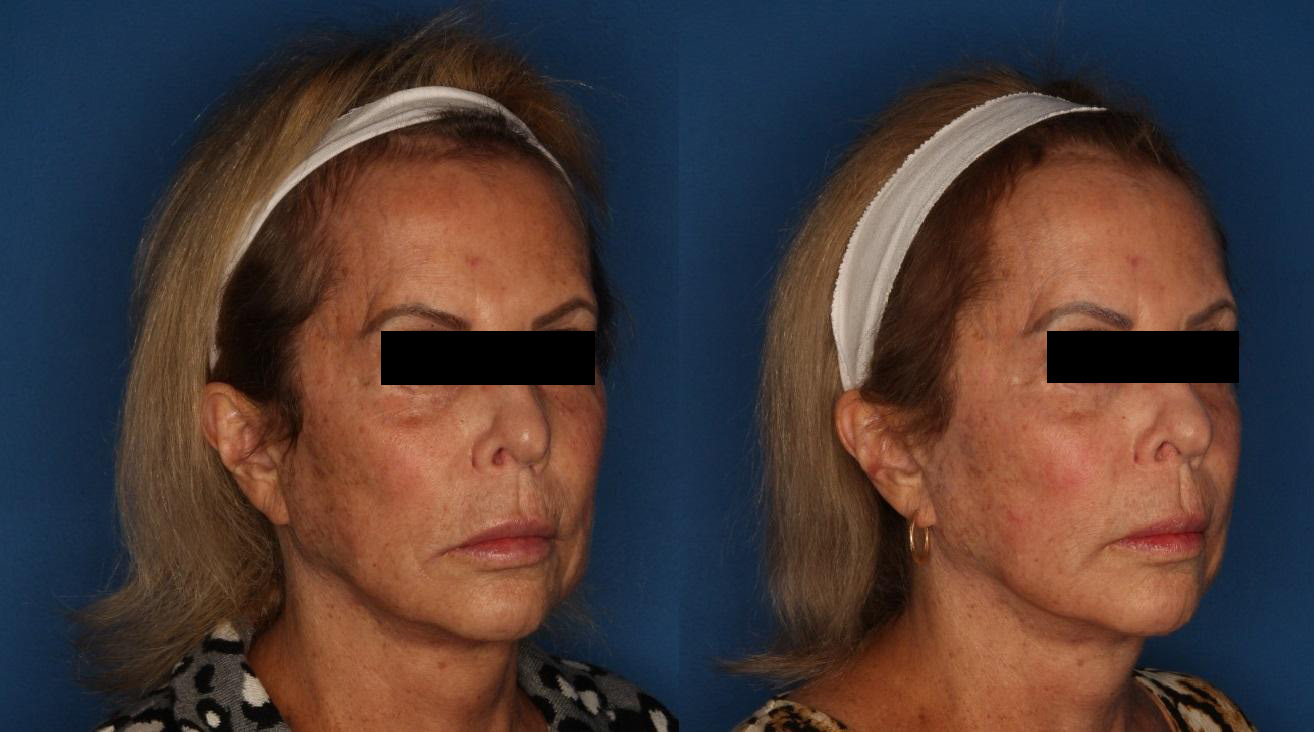 TotalFX Before & After Gallery - Patient 148036843 - Image 1