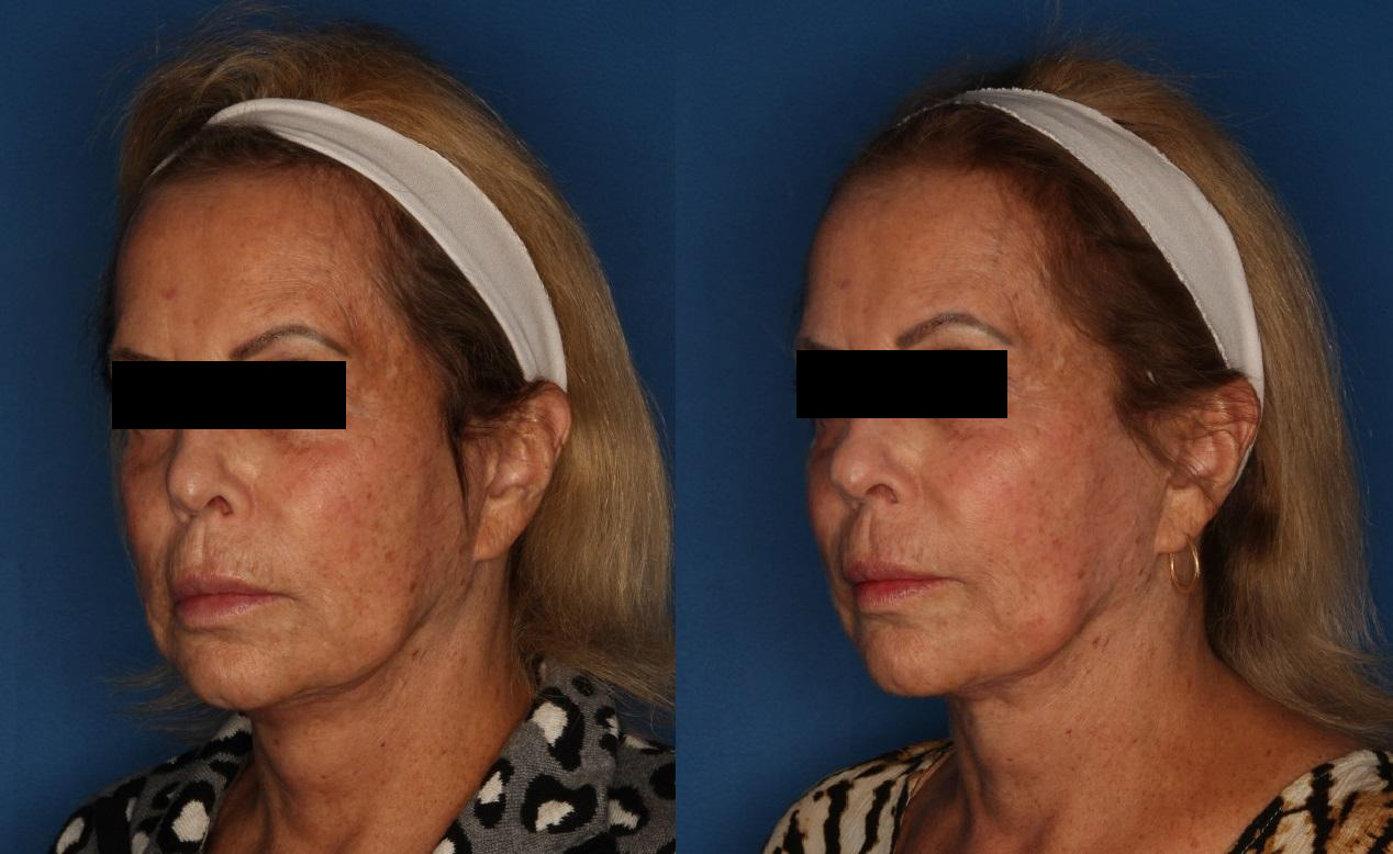 TotalFX Before & After Gallery - Patient 148036843 - Image 2
