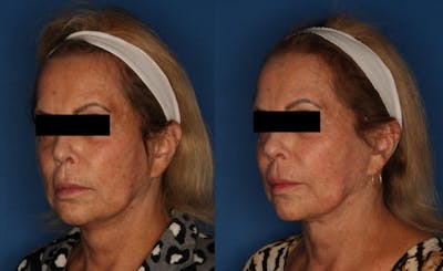 TotalFX Before & After Gallery - Patient 148036843 - Image 2