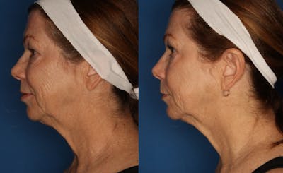 HALO® Laser by Sciton Gallery Before & After Gallery - Patient 148148201 - Image 2