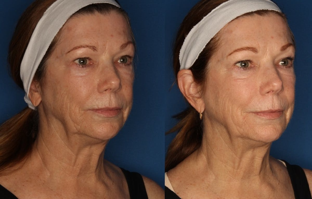 HALO® Laser by Sciton Before & After Gallery - Patient 148148201 - Image 1