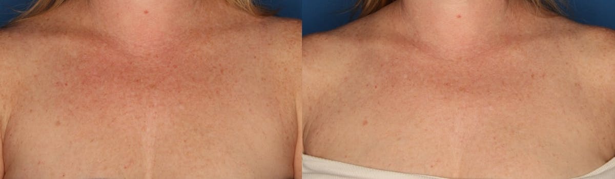 Ultherapy Before & After Gallery - Patient 148148214 - Image 1