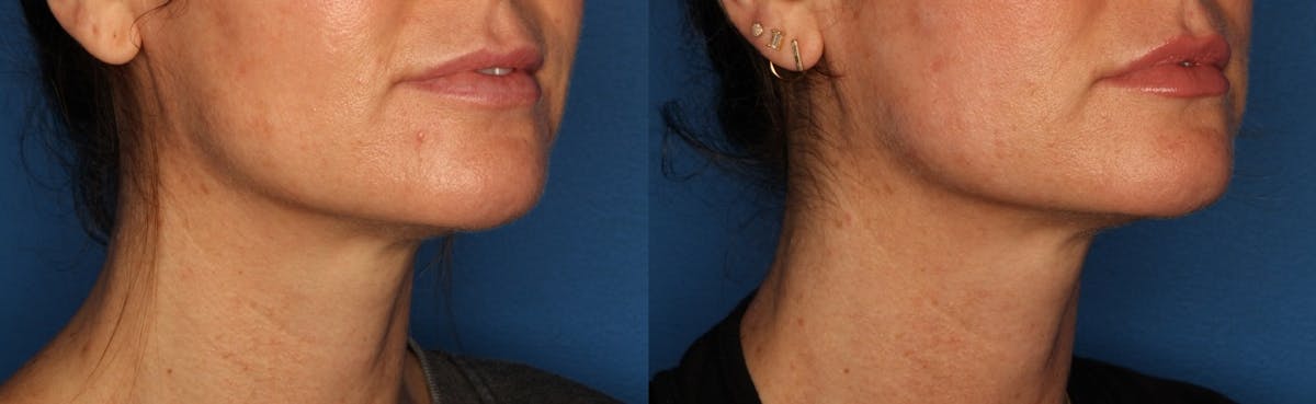 Morpheus8 Before & After Gallery - Patient 148678963 - Image 1