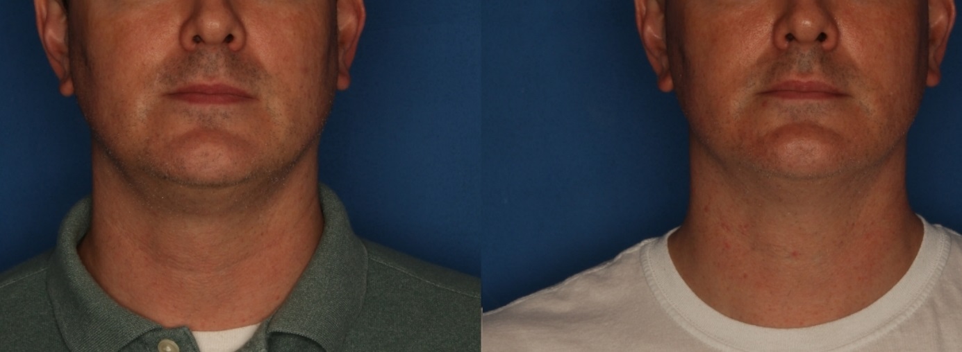 Morpheus8 Before & After Gallery - Patient 154105897 - Image 1