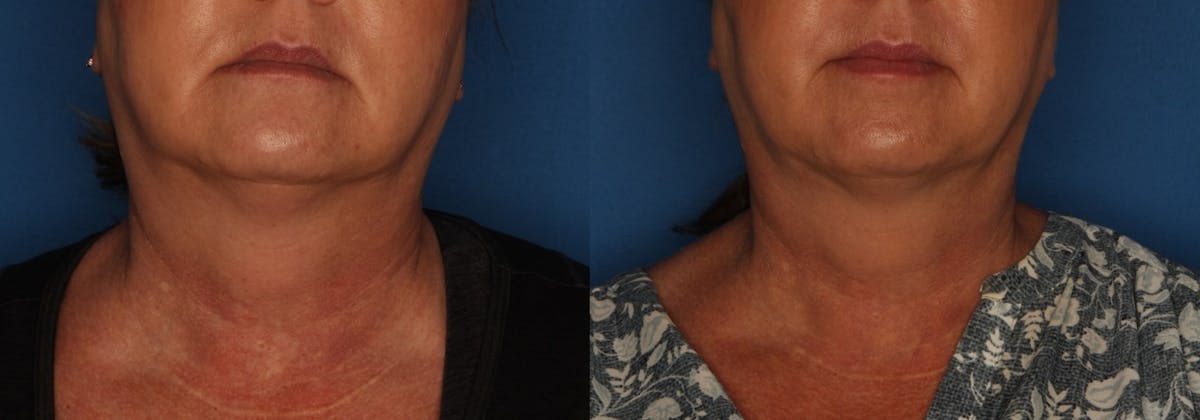 Kybella Gallery Before & After Gallery - Patient 154106200 - Image 1