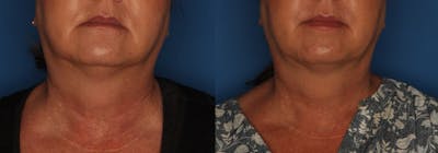 Kybella Before & After Gallery - Patient 154106200 - Image 1