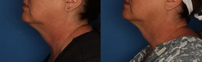 Kybella Gallery Before & After Gallery - Patient 154106200 - Image 2