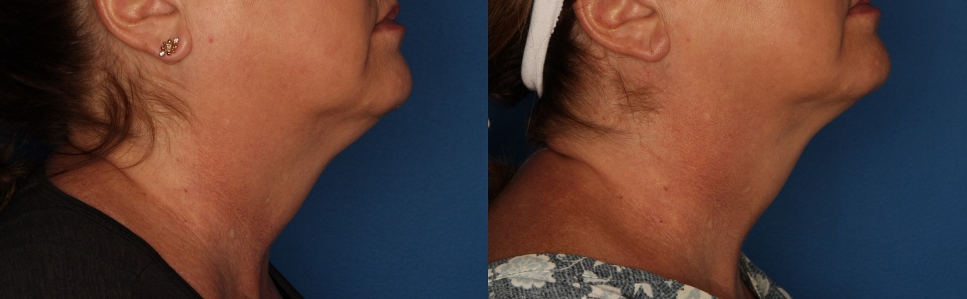 Kybella Gallery Before & After Gallery - Patient 154106200 - Image 3