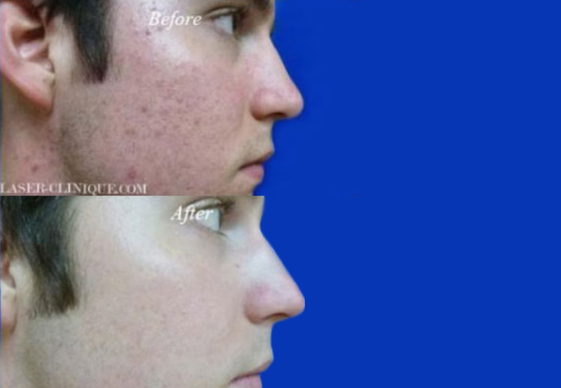 Acne Treatment San Diego Laser Clinique