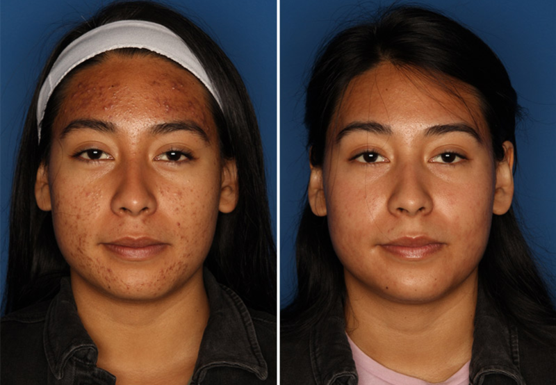Acne Treatment San Diego Laser Clinique