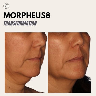 Morpheus8 Before & After Gallery - Patient 166801079 - Image 1