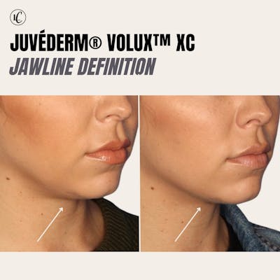 Jawline Augmentation Gallery Before & After Gallery - Patient 166801082 - Image 1