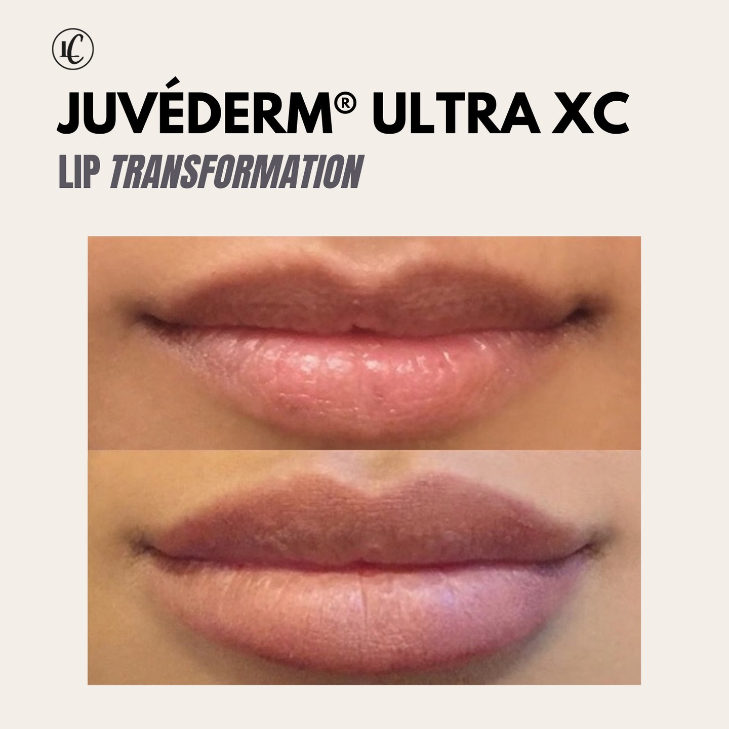 Lip Fillers Before & After Gallery - Patient 166801089 - Image 1