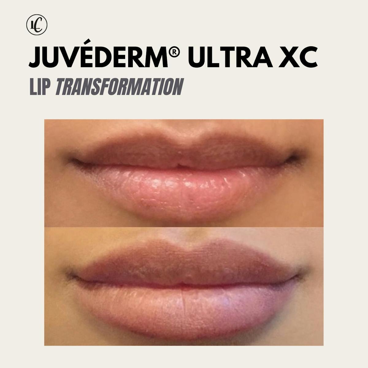 Juvederm Ultra XC Before & After Gallery - Patient 166801087 - Image 1