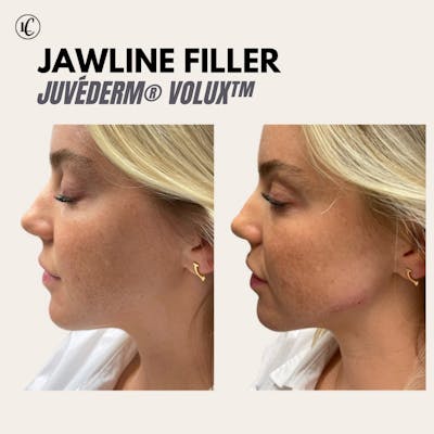 Juvederm Volux XC Before & After Gallery - Patient 166801091 - Image 1