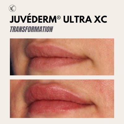 Lip Augmentation Before & After Gallery - Patient 166801342 - Image 1