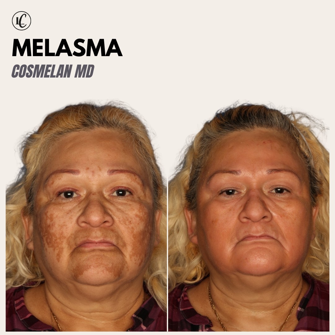 Cosmelan Peel Before & After Gallery - Patient 166801600 - Image 1