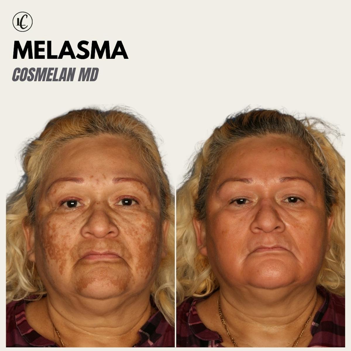 Cosmelan Peel Before & After Gallery - Patient 166801600 - Image 1