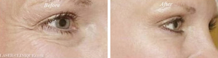 Botox/ Dysport/ Xeomin Before & After Gallery - Patient 243911 - Image 1