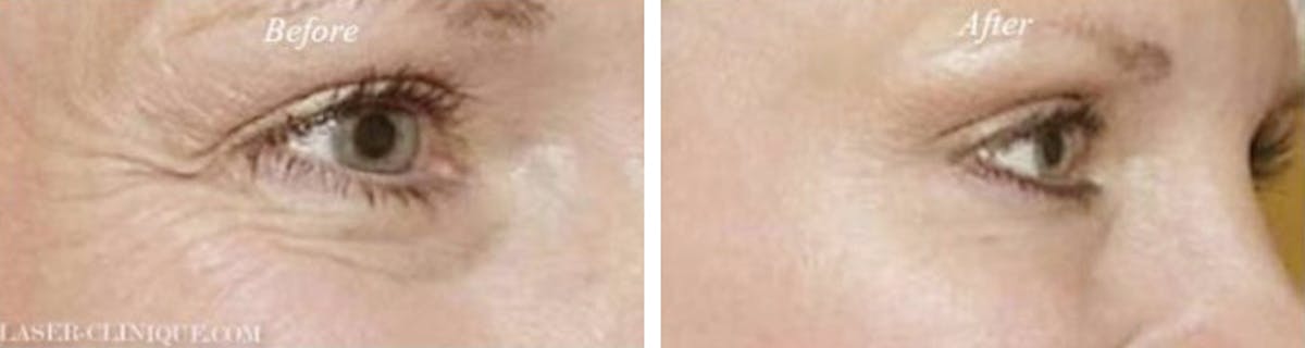 Botox/ Dysport/ Xeomin Gallery Before & After Gallery - Patient 243911 - Image 1