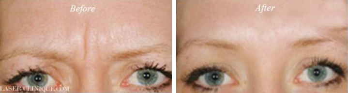 Botox/ Dysport/ Xeomin Before & After Gallery - Patient 149654 - Image 1