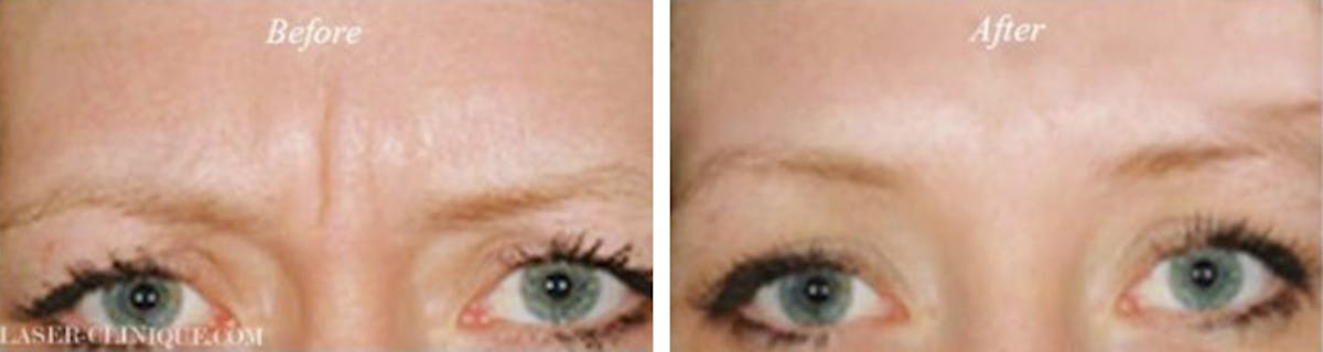 Botox/ Dysport/ Xeomin Gallery Before & After Gallery - Patient 149654 - Image 1
