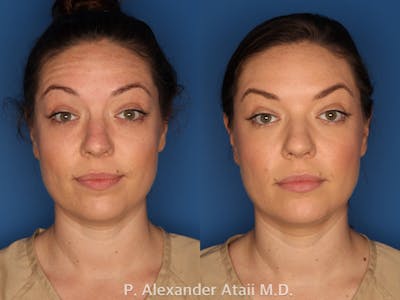 Botox/ Dysport/ Xeomin Gallery Before & After Gallery - Patient 751159 - Image 4