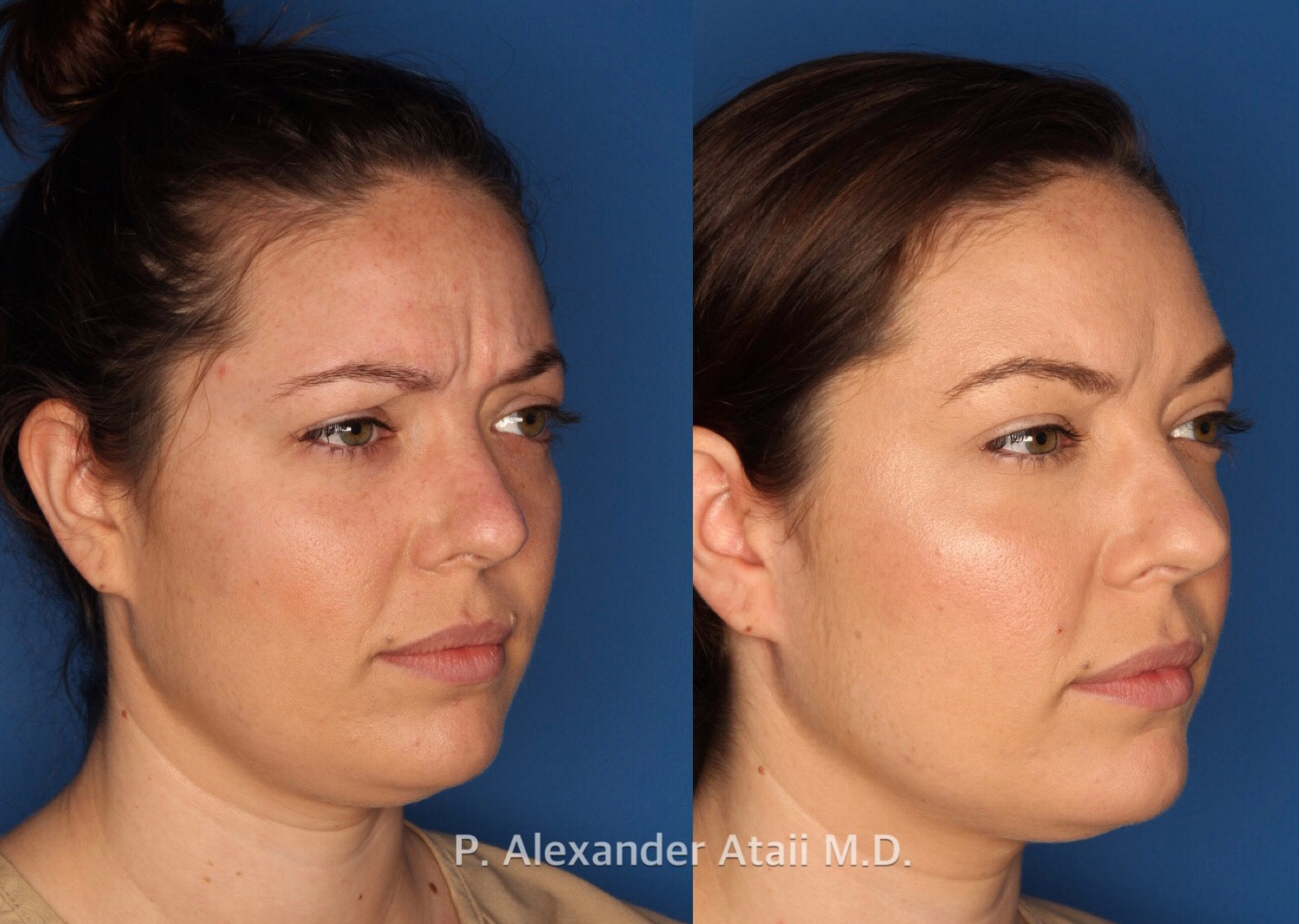 Botox/ Dysport/ Xeomin Gallery Before & After Gallery - Patient 751159 - Image 3