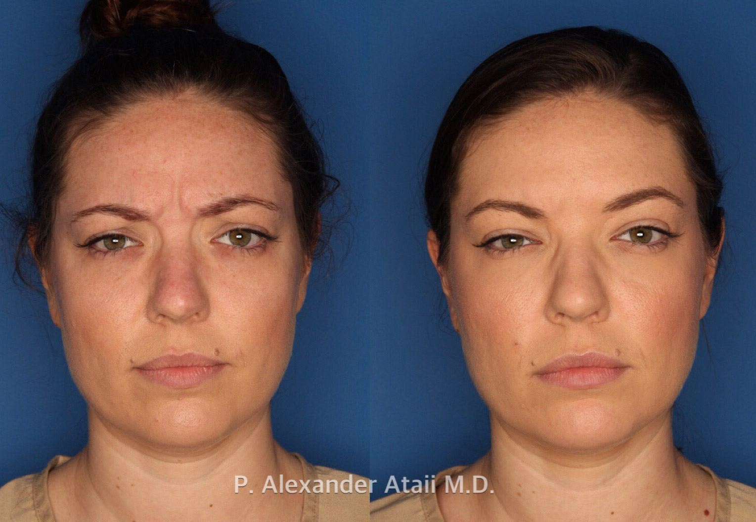 Botox/ Dysport/ Xeomin Before & After Gallery - Patient 751159 - Image 2