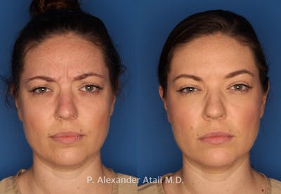 Botox/ Dysport/ Xeomin Gallery Before & After Gallery - Patient 751159 - Image 2