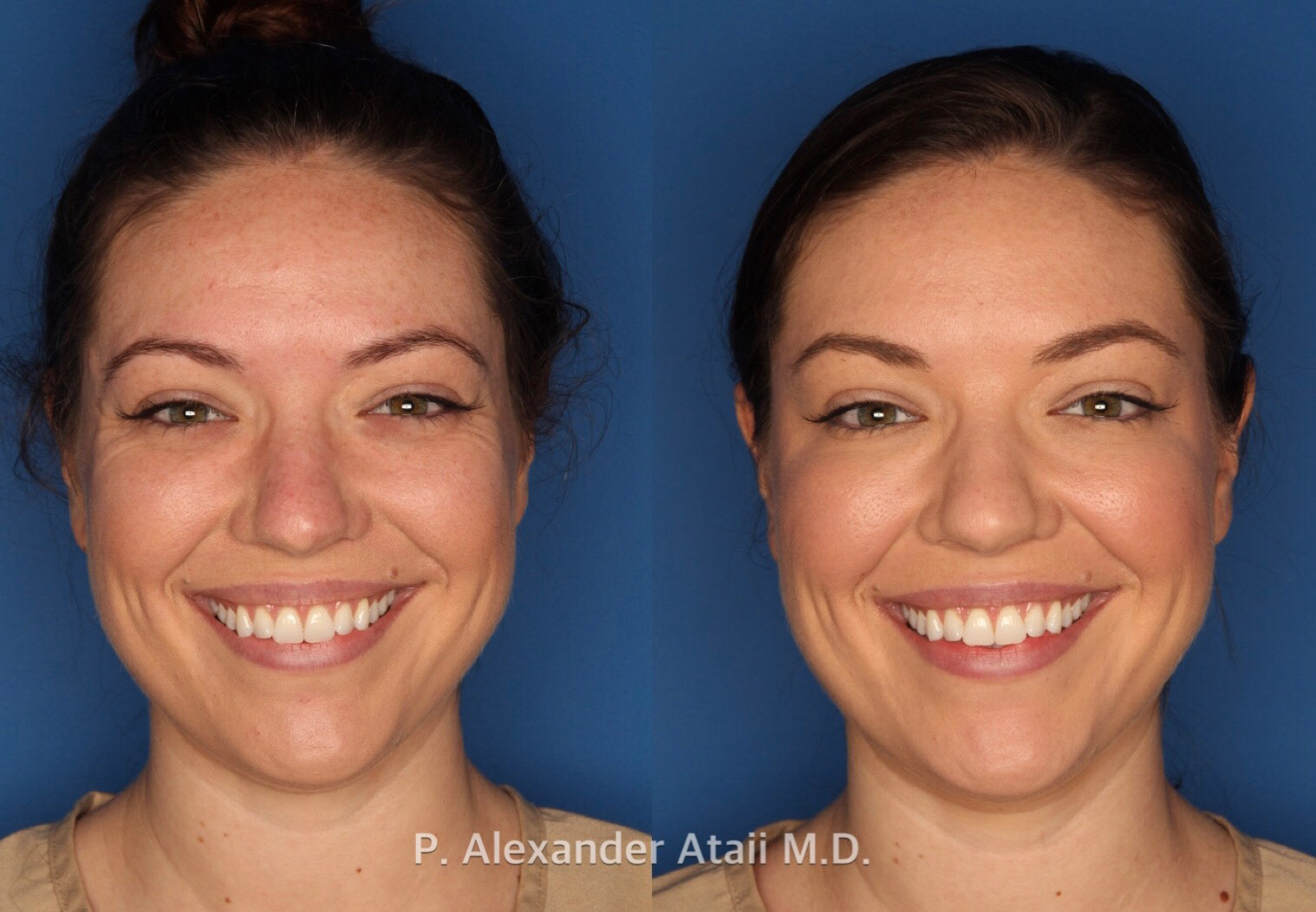 Botox/ Dysport/ Xeomin Before & After Gallery - Patient 751159 - Image 1