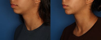 Dermal Fillers Gallery Before & After Gallery - Patient 212600 - Image 2