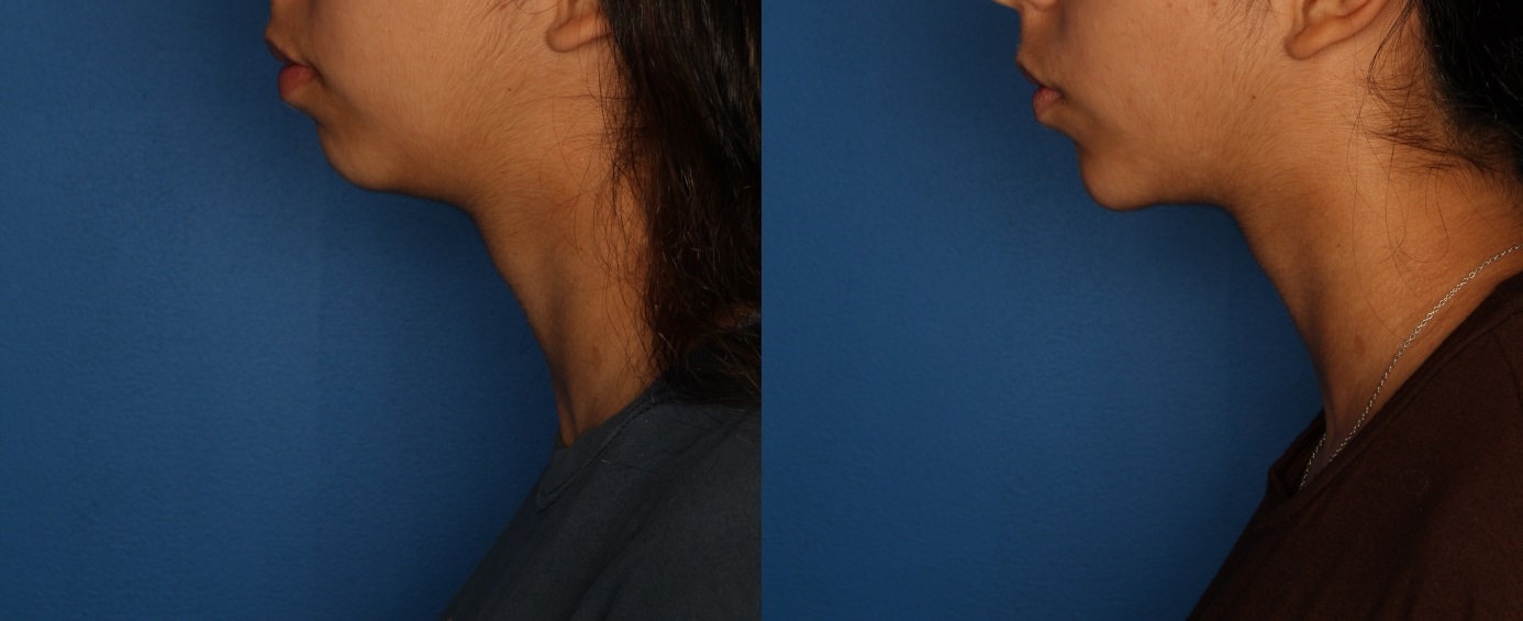 Dermal Fillers Before & After Gallery - Patient 212600 - Image 3
