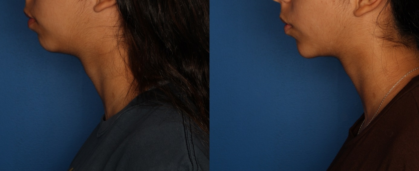 Dermal Fillers Gallery Before & After Gallery - Patient 212600 - Image 5