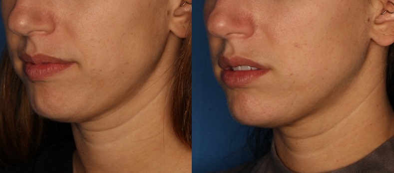 Dermal Fillers Before & After Gallery - Patient 310241 - Image 2
