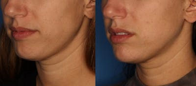 Dermal Fillers Gallery Before & After Gallery - Patient 310241 - Image 2