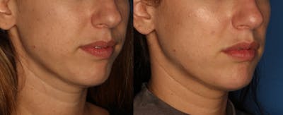 Dermal Fillers Before & After Gallery - Patient 310241 - Image 1