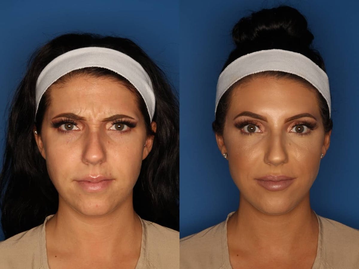 Botox/ Dysport/ Xeomin Before & After Gallery - Patient 158211 - Image 1