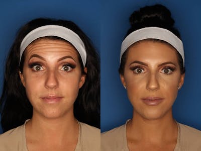 Botox/ Dysport/ Xeomin Gallery Before & After Gallery - Patient 158211 - Image 2