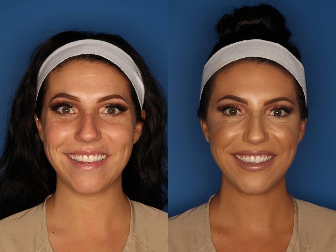 Botox/ Dysport/ Xeomin Gallery Before & After Gallery - Patient 158211 - Image 3