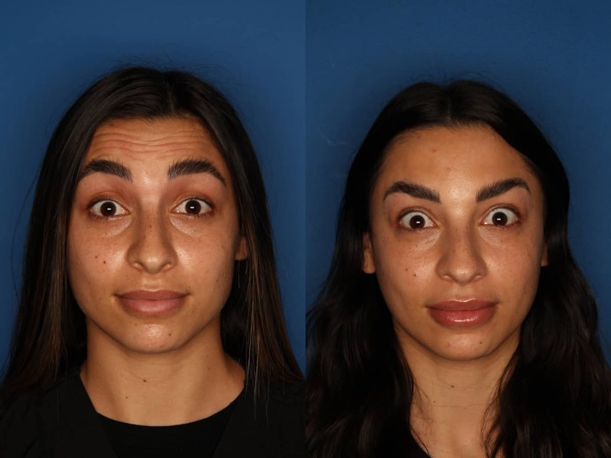 Botox/ Dysport/ Xeomin Before & After Gallery - Patient 321902 - Image 1