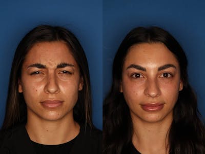 Botox/ Dysport/ Xeomin Gallery Before & After Gallery - Patient 321902 - Image 2