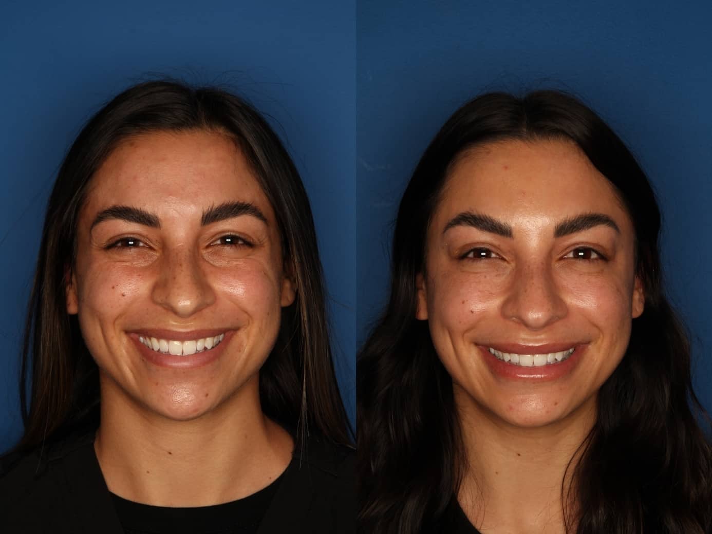 Botox/ Dysport/ Xeomin Before & After Gallery - Patient 321902 - Image 3