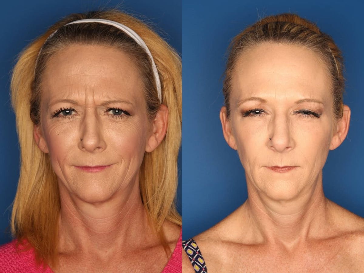 Botox/ Dysport/ Xeomin Before & After Gallery - Patient 330125 - Image 1