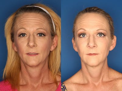 Botox/ Dysport/ Xeomin Gallery Before & After Gallery - Patient 330125 - Image 2