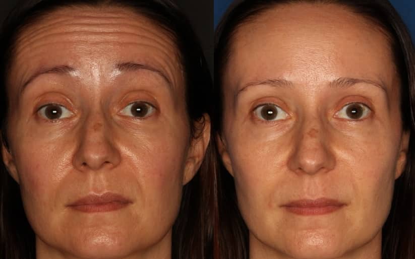 Botox/ Dysport/ Xeomin Before & After Gallery - Patient 588933 - Image 1