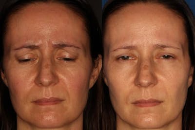 Botox/ Dysport/ Xeomin Before & After Gallery - Patient 588933 - Image 2