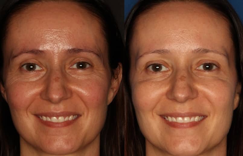 Botox/ Dysport/ Xeomin Before & After Gallery - Patient 588933 - Image 3